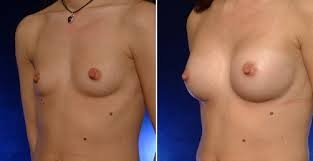 Foto van groeiende borsten